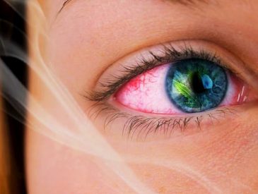 Do Edibles Make Your Eyes Red Yes! Why