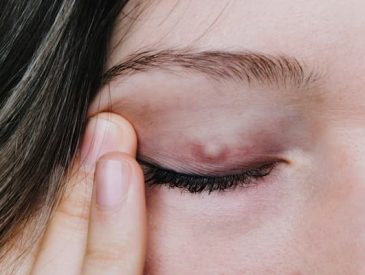 Styes What is It Causes & Treatments & Prevention (The Ultimate Guide)