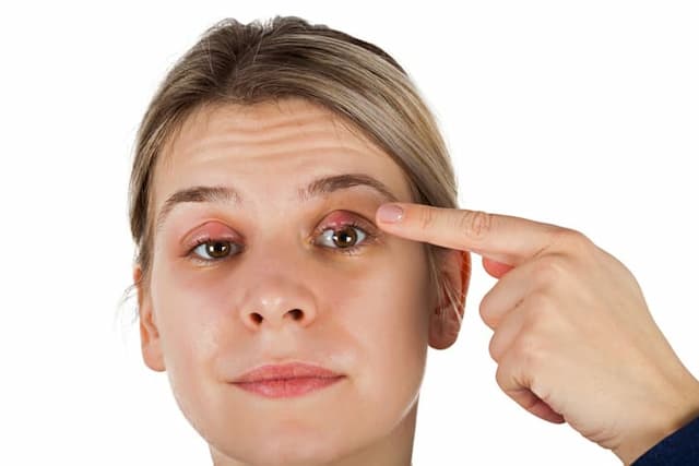 Is a Stye Contagious All You Want to Know